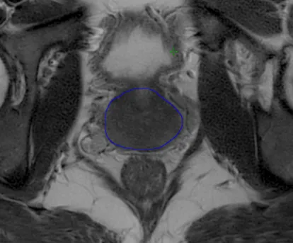 FIGURE 8. An example of the delineation (blue line) of the prostate in one slice.