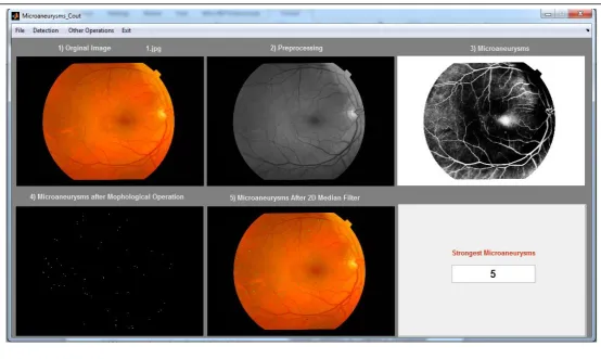 Figure 6: Graphical User Interface for detection and count the Microaneurysms 