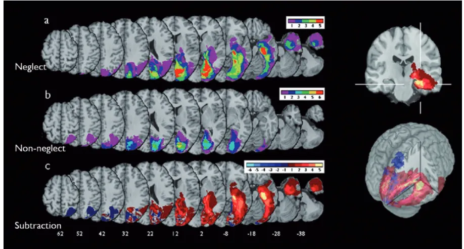 Figure 4: Illustrates how lesion overlap studies based upon the use of spatially normalised magnetic resonance images can be used to identify spatially localised brain regions in which damage is highly predictive of particular forms of functional impairmen