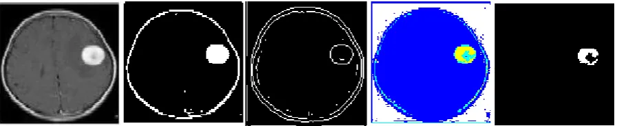 Fig 1.1 Brain MR images: (a) is a original image and (b),(c),(d) and (e) are corresponding segmented images