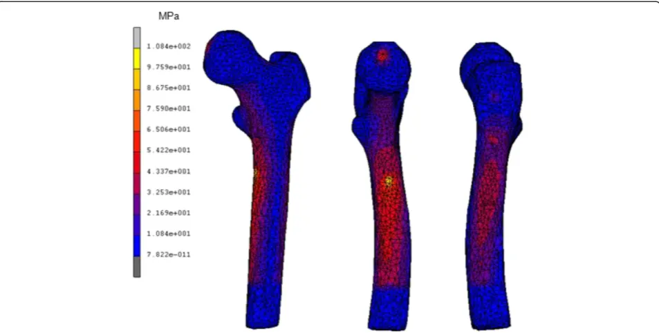 Figure 8 Contour plots of equivalent von Mises stress using stair climbing loading from (a) frontal view, (b) medial view and(c) lateral view.