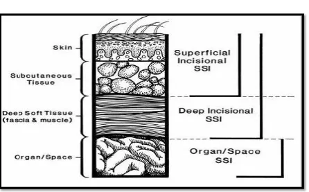 Figure no. 1: Cross section of abdominal wall depicting CDC classification of 