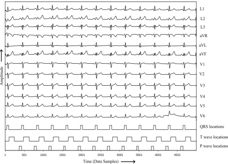 Fig. 3 P and T-wave detection in record MO1_116 of CSE ECG database  