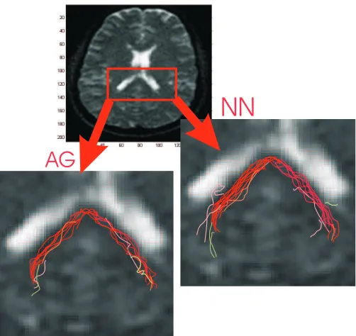 Figure 3: Tracking results for the corpus callosumthe human brain. Left: tracts obtained with the trackingalgorithm tuned-up with the proposed AG, Right: pa- area oframeter estimation with NN.