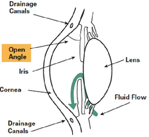Figure 1.2: Open-angle and angle-closure glaucoma [6]