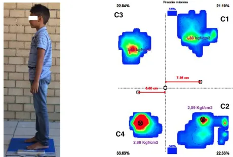Figure 2. Bipodal frontal support posture of the measurement protocol. 