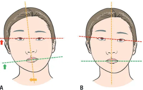 Fig. 1. Schematic illustrations. (A) Natural head position. In the natural head position with a horizontal visual axis, a difference in height of the oral commissures is apparent