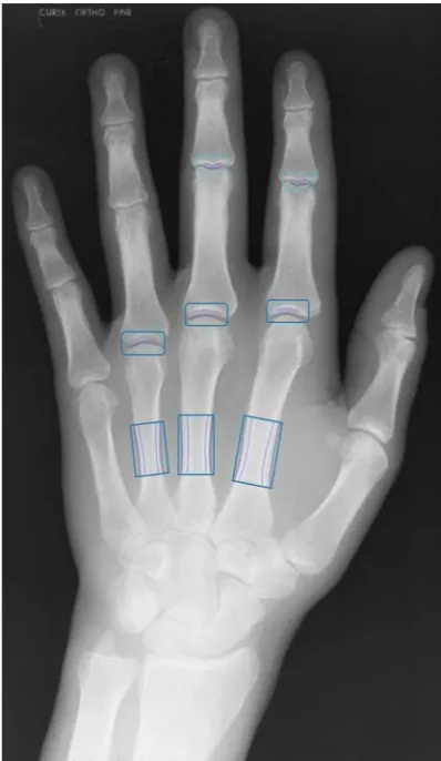 Figure 2 Radiograph of hand with highlighted measurement regions. Posteroanterior radiograph of the left hand with measurement boxes placed at MCP 2, 3 and 4 in order to measure joint space width