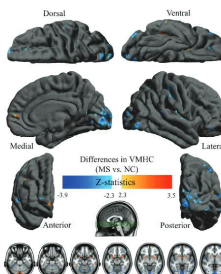 FIG 1. Whole-brain voxelwise homotopic RSFC pattern by use of multiple linear regressionmodels in control (A) and MS (B) groups