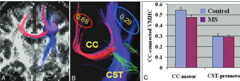 FIG 6. Interhemispheric and intrahemispheric structural and functional connectivity of cortical motor regions.regions
