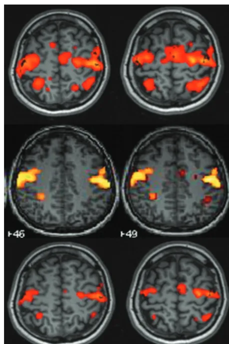 Table 2: Comparison between Neuro3D and SPM analysis in motor paradigm experiments