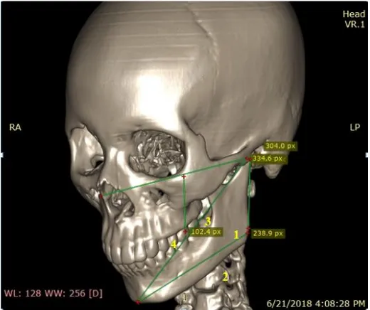 FIG: 8  Right side asymmetry measurement used to calculate craniofacial 