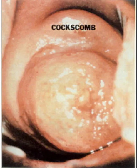 Figure 1: Cervical collar with pseudopolyp and cockscomb 