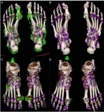 Figure 2Resolution of tophi after exposure to pegloticase. Three-dimensional dual-energy CT images from a chronictophaceous gout patient responding to pegloticase (A and B) and from a patient showing partial response (C and D)