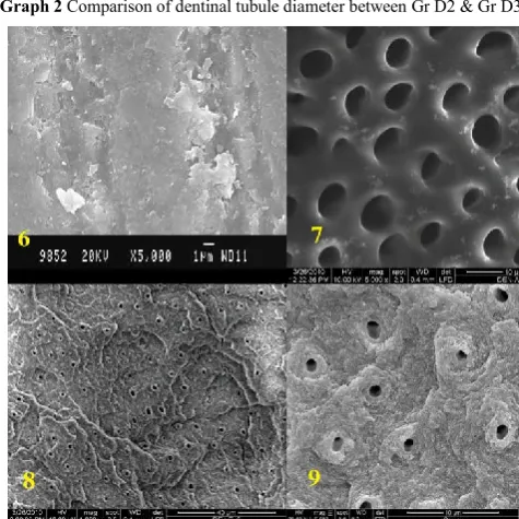 Figure 6 Gr D1 (dentin control)Note the smear layer covered surface Figure 8Figure 7 Gr D2(acid etched dentin surface) Note the open dentinal tubules Figure 9showing funnel shaped configuration  Gr D3 (lased dentin surface seen at 1300X magnification) Note the roughness and the recrystallized surface  GrD3 (lased dentin surface at 5000X magnification Note the open dentinal tubules, roughness scaling and cuff of peritubular dentin 