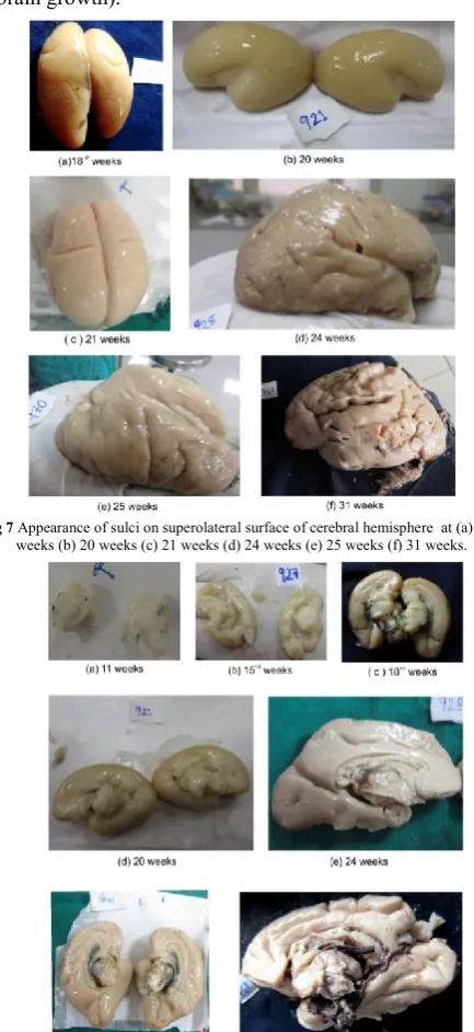 Fig 7  Appearance of sulci on superolateral surface of cerebral hemisphere  at (a) 18+2 