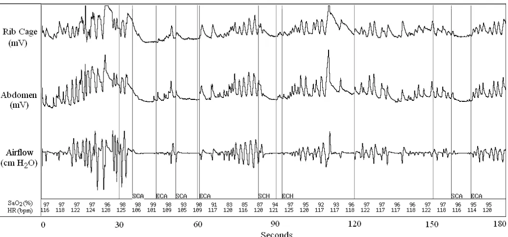 Figure 1: In this 180-second PSG recording, a 9-year-old female with an OA that led to significant cardiac variations when compared to the prior  tidal breathing baseline can be observed