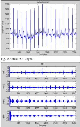 Fig. 3: Actual ECG Signal