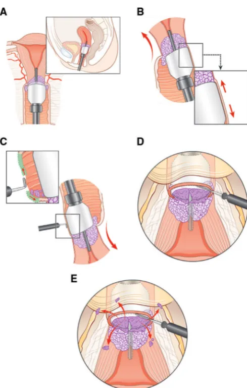 Figure 1 (A-E). Selected surgical steps of total laparoscopic radical hysterectomy/robotic radical hysterectomy (TLRH/RRH)