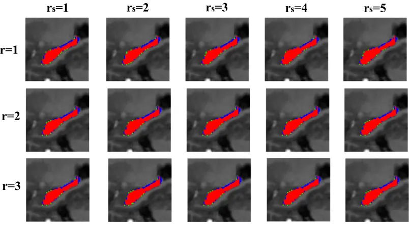 Figure 3.3: Sagittal views of the segmentations produced by diﬀerent patch radius andsearched patch radius