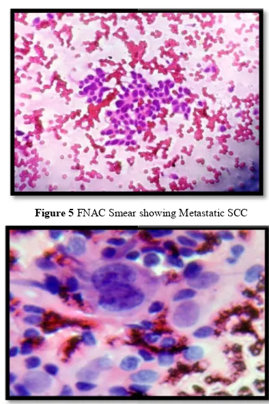 Figure 5 FNAC Smear showing Metastatic SCCFNAC Smear showing Metastatic SCC 