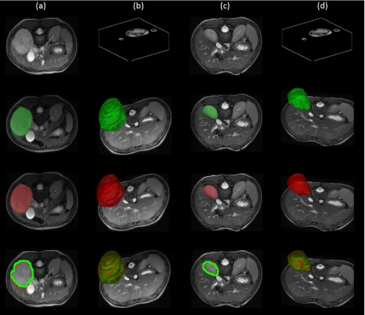 Fig. 6: Illustration of the importance of our semi-automatic segmentation method from selected slices in the 3Dscan: (a) Input scan with ill-deﬁned boundary