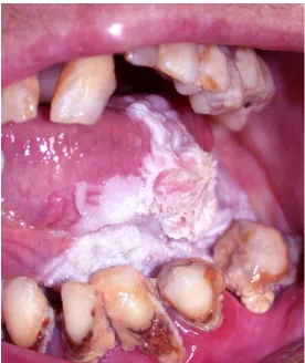 Figure 7 Leukoplakia 