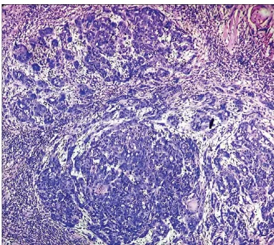 Figure 15 Papillary squamous cell carcinoma 