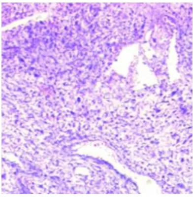 Figure 17 Sarcomatous squamous cell carcinoma 