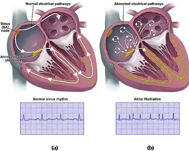 Figure 1.1 Electrical differences in heart with normal sinus rhythm (a) and heart with atrial fibrillation (b) [2] 