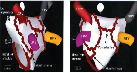 Figure 1.3 Lesions created using multiple discrete ablation points (shown in red) [13] 