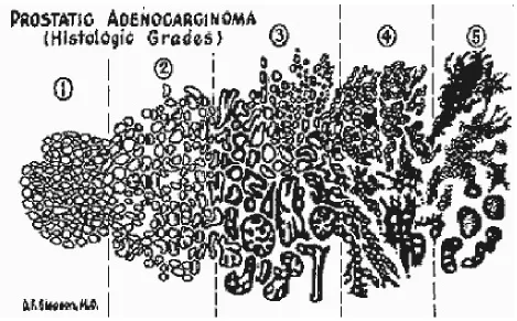 Figure 1.4: Gleason score patterns which was drawn by Dr. Gleason Courtesy: [3].