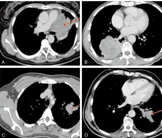 Figure 2. Pulmonary function of the two groups before and after treatment. A. Lumps at Hilum pulmonis, enveloping a bronchus and causing slight damage to bronchial wall, with less and light obstructive changes