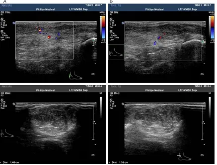 Figure 1. Ultrasound (US) imaging features of the patient at different points in time: the pictures above show blood flow in the Achilles tendon, while the corresponding pictures below display the degree of Achilles tendon swelling