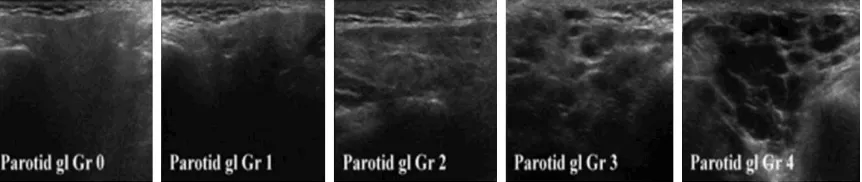 Figure 1. Representative image of the parotid gland ultrasonography with different scores.