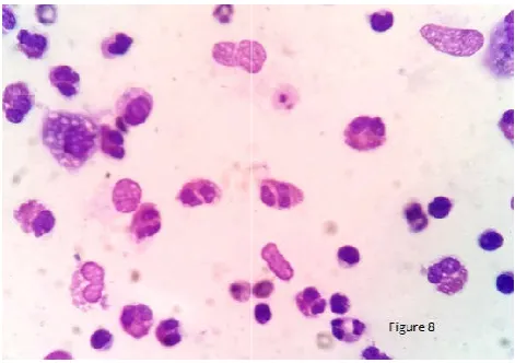 Figure 8 Smear showing many eosinophils with occasional macrophages Smear showing many eosinophils with occasional macrophages in case of eosinophilic effusion (H&E, 1000 x)eosinophilic effusion (H&E, 1000 x)  
