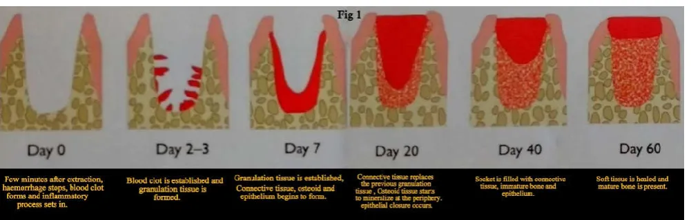 Fig 2d) Buccal wall must be kept to prevent bone loss in this area,   