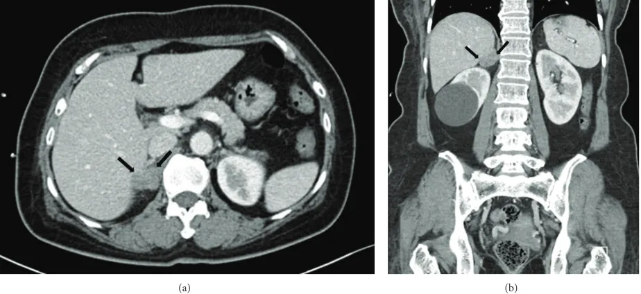 Figure 4: Axial (a) and coronal (b) abdominal computed tomography images during the late arterial phase show a 1.5 cm mass with a lobulatedcontour and mild enhancement in the right adrenal gland (black arrow).