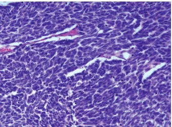 Figure 5: Microscopic findings of the right axillary mass showed diffuse sheets of basophilic tumor cells ((a) HE ×200) with large andCharacteristic paranuclear dot-like staining of CK20 is specific for MCC ((d) CK20 × ×pale staining nucleus and tiny nucle