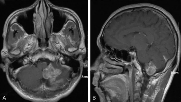 Figure 3. Male, 76 years old, pseudotumor-type cerebellar infarction in PICA perfusion territory