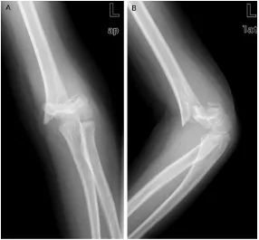 Figure 1. The anteroposterior (A) and lateral radiographs (B) showed the significant displaced supracondylar humerus fracture with the rotational deformity