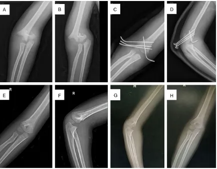 Figure 3. Radiographs showed a displaced supracondylar humerus fracture in right elbow (A and B)