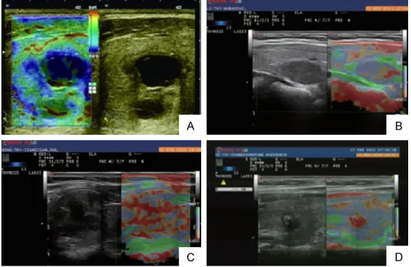 Figure 1. RTE images of the thyroid nodules with different grades in elasticity scoring system