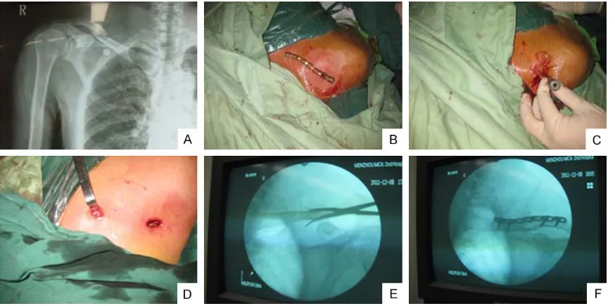 Figure 1. Minimally invasive percutaneous plate osteosynthesis (MIPPO) procedure. A. Anteroposterior view of the clavicle fracture