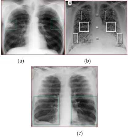 Fig. 1.Consolidation with air bronchogram  