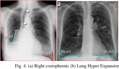 Fig. 3. (a) Left lower lobe cavity (b) Left lower lobe cavity - frontal view                    - lateral view 