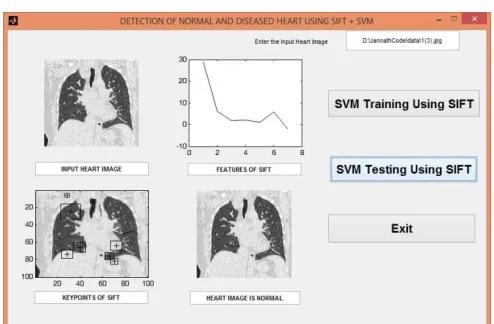 Fig.10. Screen shot for Detection of Normal Heart Using SIFT and SVM 