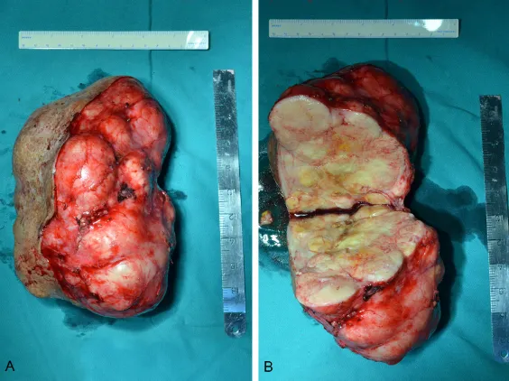 Figure 4. Post-operative histopathological image of the giant tumor. The histopathological result consisted with pleomorphic adenoma, comprising cystic-necrotic foci
