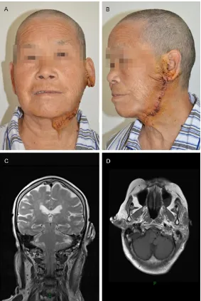Figure 5. Post-operative clinical images and MRI images. The patient got obvious cosmetic outcomes