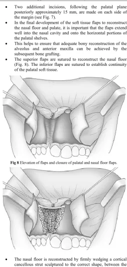 Fig 8 Elevation of flaps and closure of palatal and nasal floor flaps. 